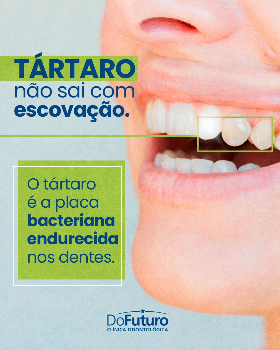 Sabia que certas impurezas acumuladas nos dentes se tornam resistentes aos cuidados diários em casa? | Clínica do Futuro